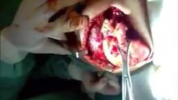 Removal of maxillary tumour